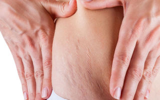 Как избавиться от растяжек во время беременности — профилактические меры и народные способы лечения