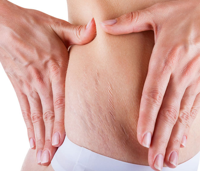 Что такое растяжки