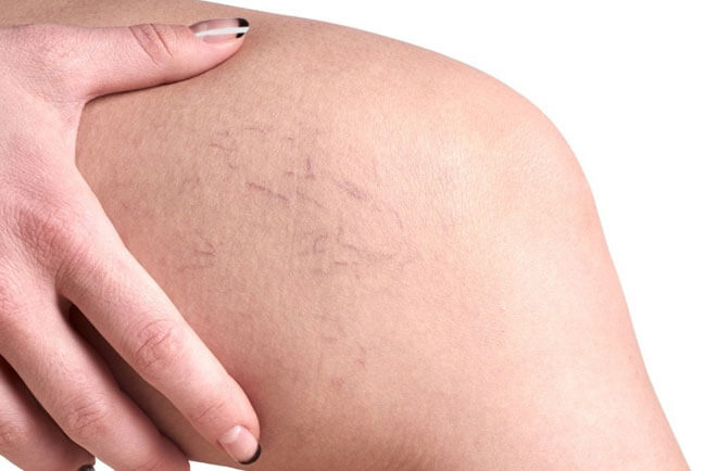 Признаки варикоза при беременности