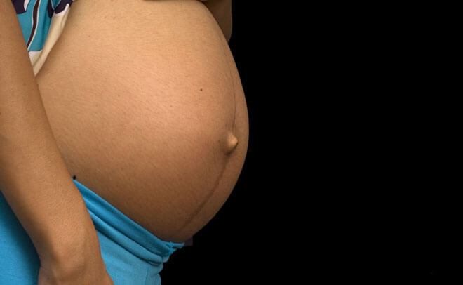 Симптомы пупочной грыжи у беременных